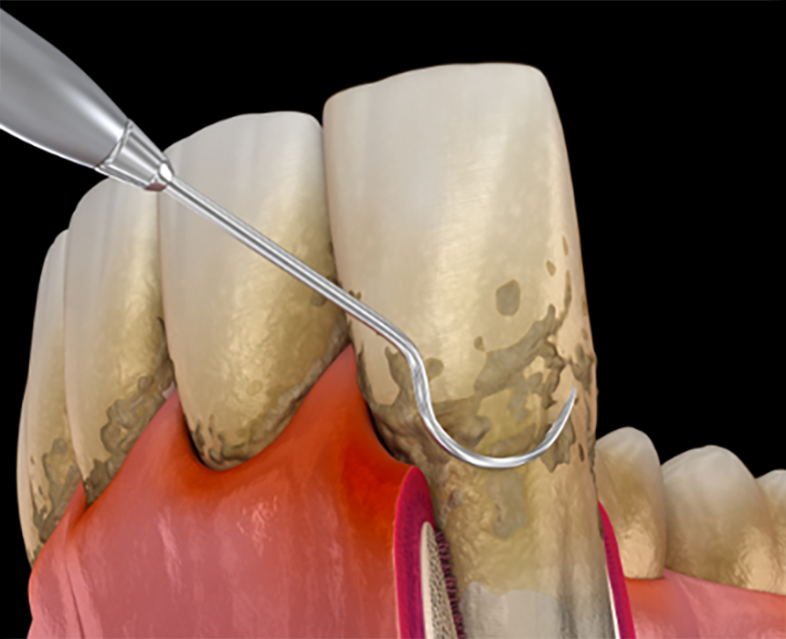 精密歯周病治療